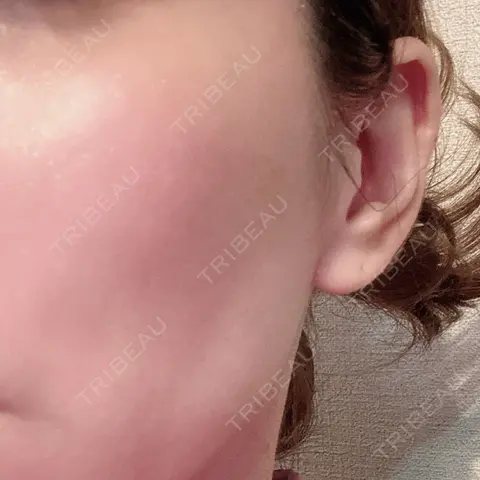 イオン導入 / 美白レーザー / 光治療（フォトフェイシャルなど） メディアージュクリニック 青山院 AFTER