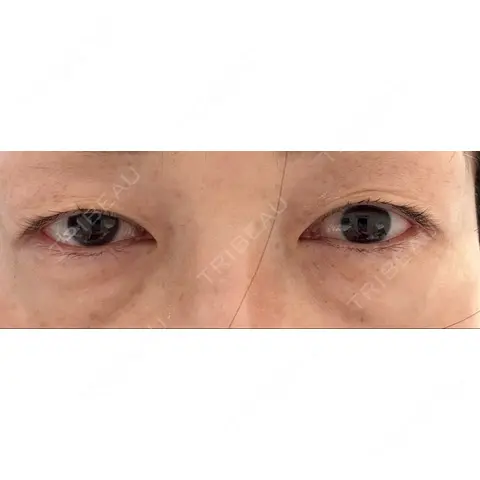 クマ治療 / 上まぶたの脂肪取り AI Beauty Clinic （エーアイ美容クリニック） AFTER
