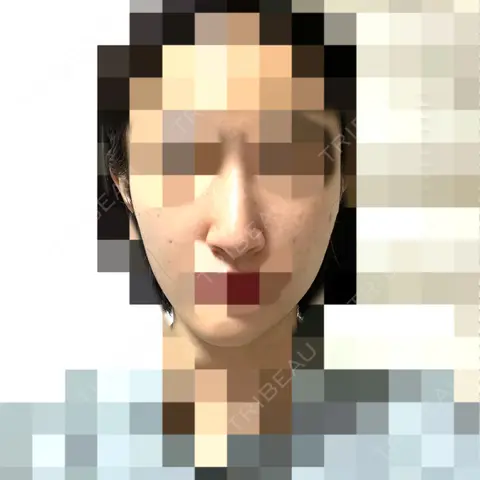 小鼻縮小（切開） / 骨切り（あご） / 骨削り（エラ） / 骨削り（頬） / 骨切幅寄せ / 輪郭修正 セギム美容整形外科 AFTER