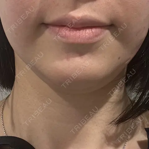 糸リフト 横浜TAクリニック AFTER