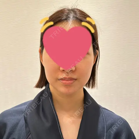 脂肪吸引（顔） / 脂肪吸引（お腹） / 脂肪吸引（腰） Mods Clinic（モッズクリニック）東京院 BEFORE