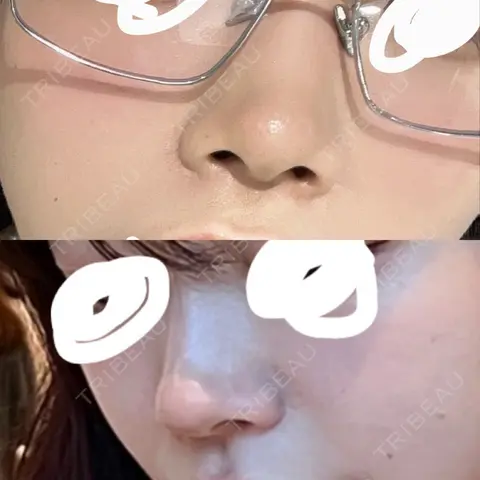 鼻尖形成（切開） / 鼻中隔延長（切開） / 小鼻縮小（切開） / 軟骨移植 / 眉間プロテーゼ グローバルビューティークリニック 銀座院 AFTER