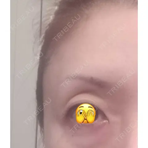 ヒアルロン酸注入（涙袋） EMMO FACE CLINIC 大宮院 AFTER