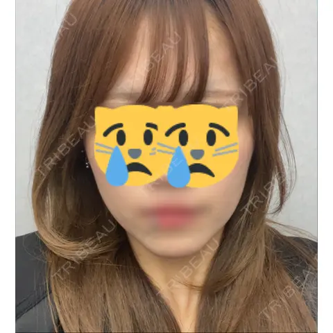 ボトックス（エラ・小顔） KARIS beauty clinic AFTER