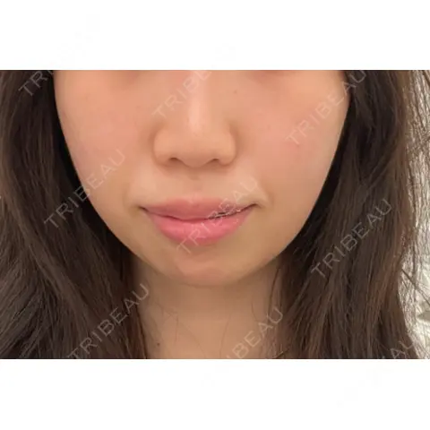 ボトックス（あご） A CLINIC（エークリニック） 新宿院 AFTER
