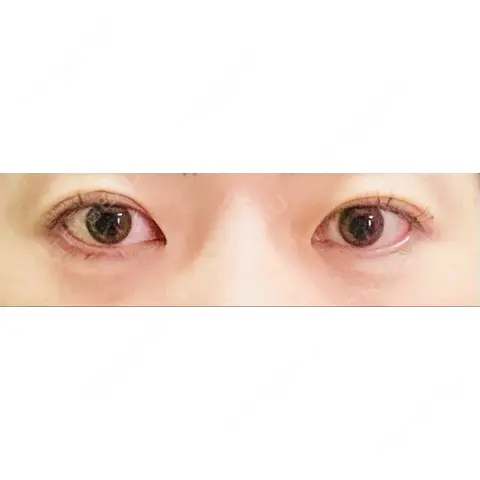 目頭切開 くさのたろうクリニック AFTER