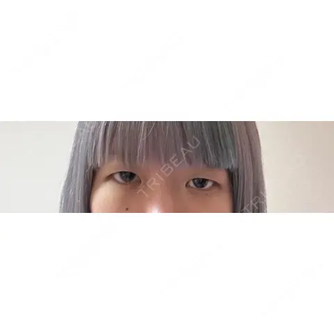 クマ治療 / タレ目形成・グラマラスライン（切開） R Beauty CLINIC 銀座院 AFTER
