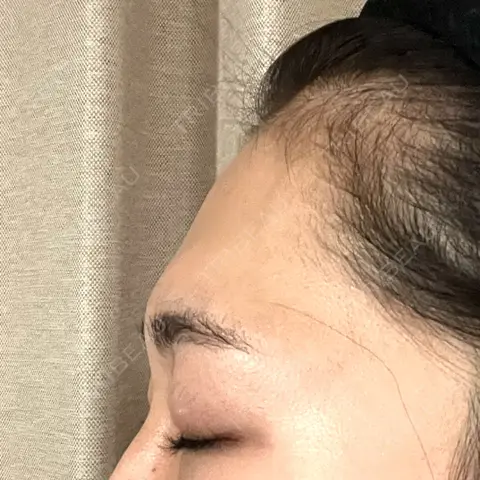 脂肪注入（額） HAAB×DREAM BEAUTY CLINIC 東京本院 BEFORE