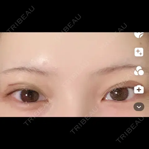 クマ治療 / 目尻切開 / タレ目形成・グラマラスライン（切開） R Beauty CLINIC 銀座院 BEFORE