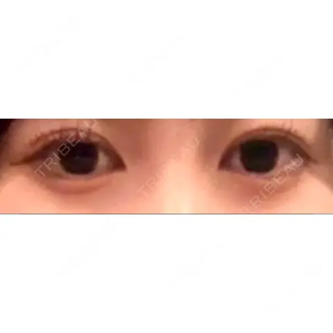 目尻切開 / タレ目形成・グラマラスライン（切開） / 自然癒着法 東京美容医療クリニック 池袋院 AFTER