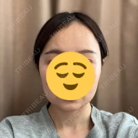 骨切り（あご） / 骨削り（エラ） / 骨削り（頬） セギム美容整形外科 AFTER