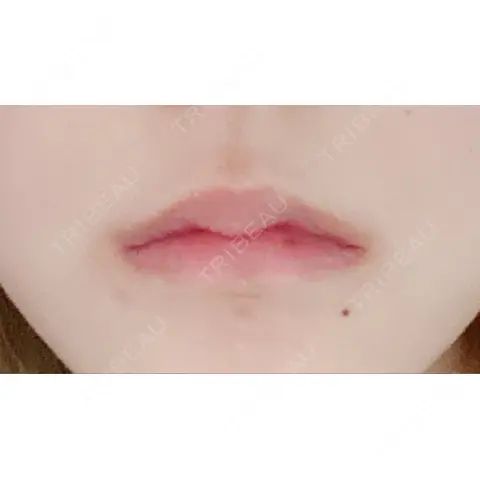 口角挙上 くさのたろうクリニック AFTER