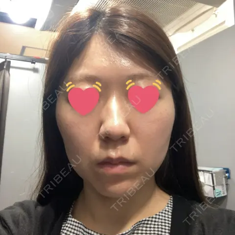 ボトックス（エラ・小顔） / その他（目元） L‘amour clinic Tokyo【ラムールクリニック東京】 AFTER