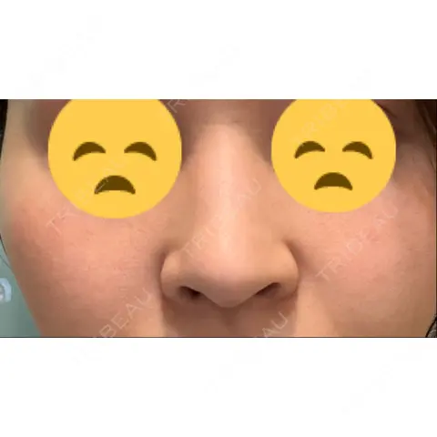 鼻尖形成（切開） / 小鼻縮小（切開） / 骨切幅寄せ / ワシ鼻修正・ハンプ切除 セギム美容整形外科 AFTER