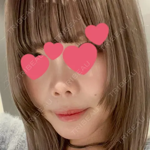 鼻中隔延長（切開） / 軟骨移植 / 鼻翼挙上 / 鼻修正 R Beauty CLINIC 大阪院 AFTER