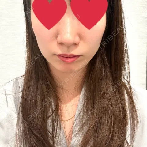 ボトックス（エラ・小顔） R Beauty CLINIC 大阪院 BEFORE