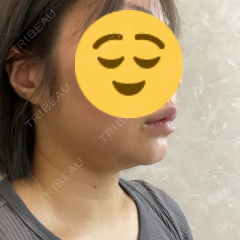 糸リフト / 脂肪吸引（顔） / ボトックス（肩） Days Beauty Clinic BEFORE