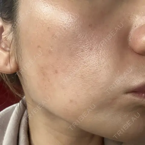 ピーリング（ニキビ・毛穴） Re:anne clinic 銀座 【リアンクリニック銀座】 AFTER