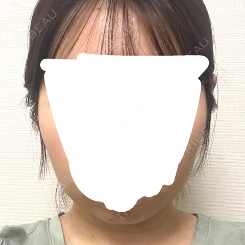 ボトックス（エラ・小顔） KARIS beauty clinic BEFORE