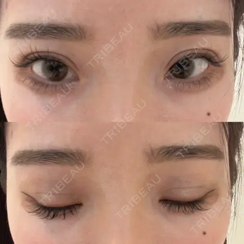 目頭切開 AI Beauty Clinic （エーアイ美容クリニック） BEFORE