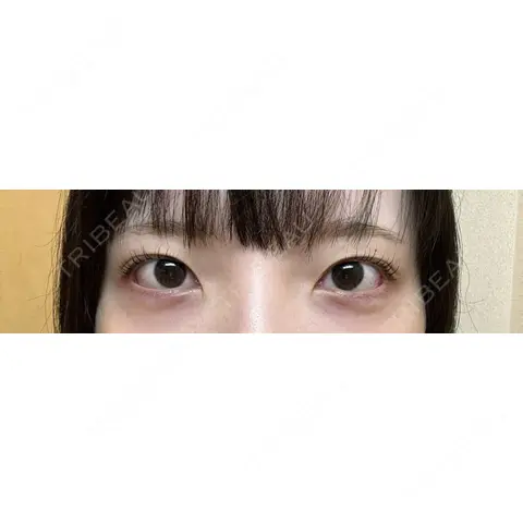 二重埋没 / 目頭切開 湘南美容クリニック 池袋東口院 AFTER