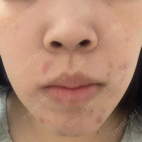 ニードルRF（ポテンツァなど） LUNA BEAUTY CLINIC GINZA BEFORE