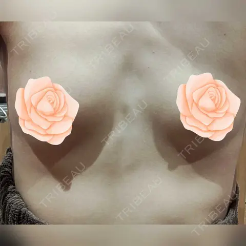 豊胸（シリコン＋脂肪併用） R Beauty CLINIC 銀座院 AFTER