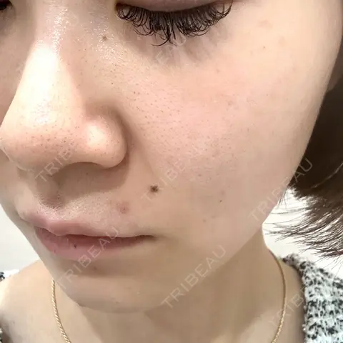 ルメッカ BAO CLINIC 梅田院 BEFORE