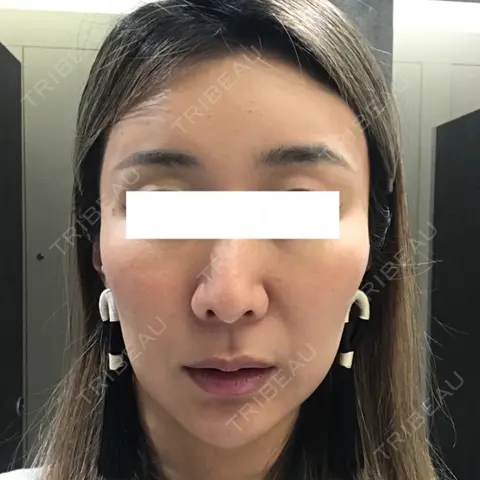 その他（輪郭） 東京イセアクリニック AFTER