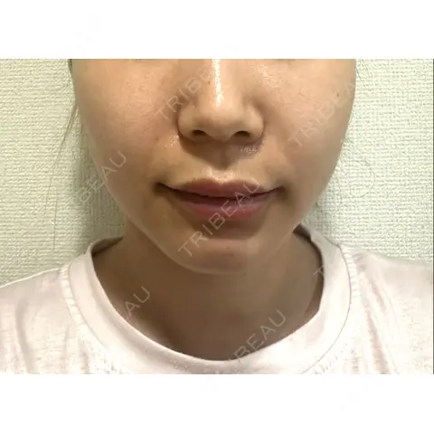 糸リフト / バッカルファット除去 / 脂肪吸引（顔） BLINC CLINIC （ブリンク クリニック） BEFORE