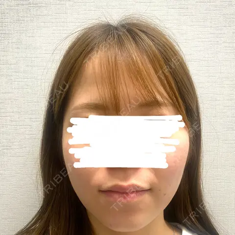 糸リフト / 脂肪吸引（顔） R Beauty CLINIC 大阪院 BEFORE