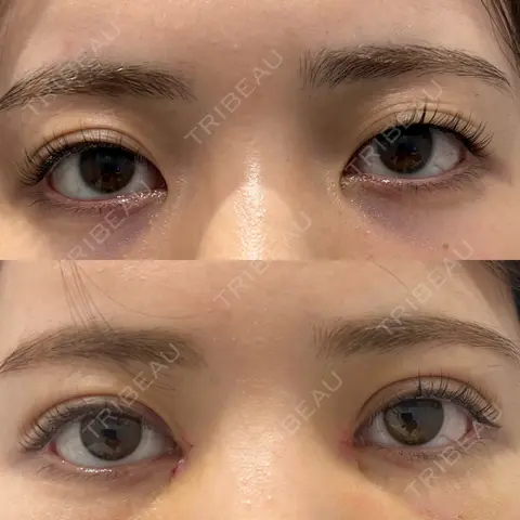 二重埋没 / 目頭切開 R Beauty CLINIC 名古屋院 BEFORE