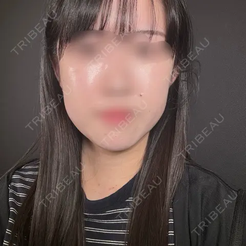 バッカルファット除去 / ジョールファット除去 R Beauty CLINIC 大阪院 BEFORE