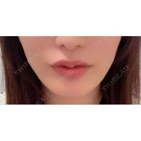 ヒアルロン酸注入（唇） R Beauty CLINIC 名古屋院 BEFORE