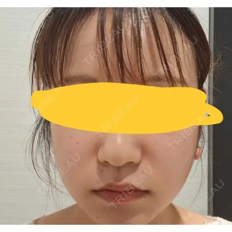 ボトックス（エラ・小顔） R Beauty CLINIC 名古屋院 BEFORE