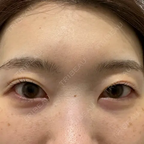 二重埋没 / クマ治療 R Beauty CLINIC 名古屋院 BEFORE