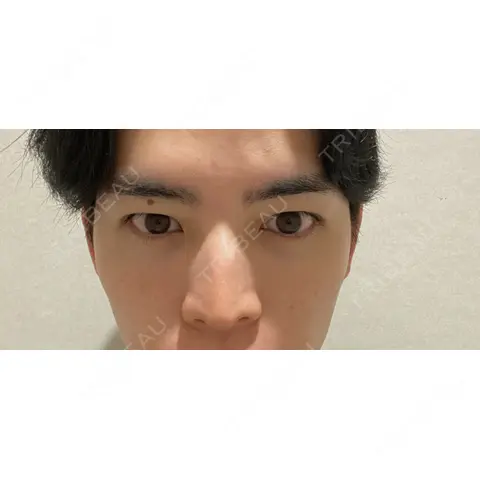 二重埋没 シェリークリニック 新宿本院 AFTER