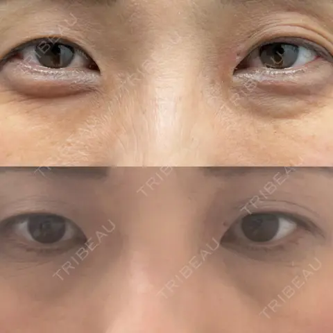 クマ治療 / 下まぶたの脂肪取り AI Beauty Clinic （エーアイ美容クリニック） AFTER