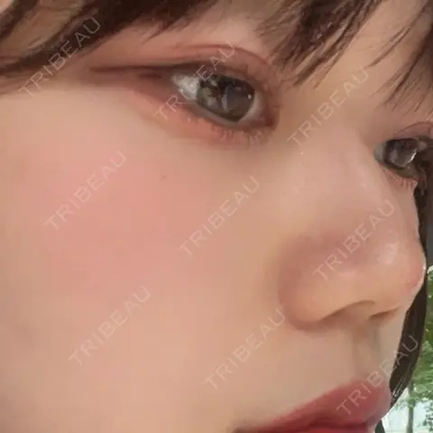ヒアルロン酸注入（鼻） / ヒアルロン酸注入（あご） HAAB×DREAM BEAUTY CLINIC 東京本院 AFTER