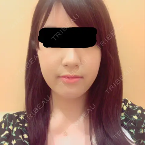 ボトックス（エラ・小顔） 品川美容外科 千葉院 AFTER