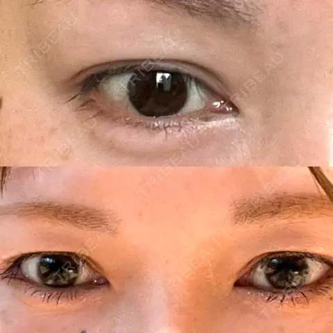 二重埋没 / ヒアルロン酸注入（涙袋） AI Beauty Clinic （エーアイ美容クリニック） AFTER