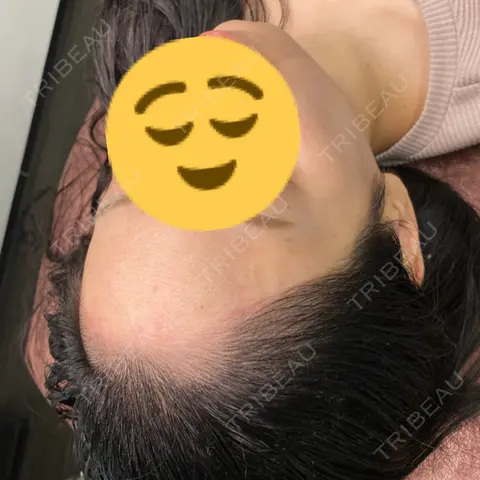 アートメイク（ヘアライン） LEAGRANT CLINIC 中目黒 BEFORE