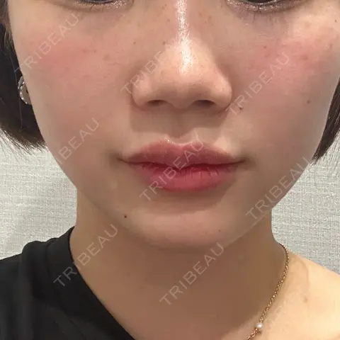 糸リフト R Beauty CLINIC 名古屋院 BEFORE