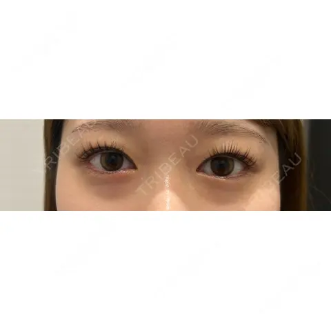 二重埋没 / クマ治療 R Beauty CLINIC 名古屋院 BEFORE