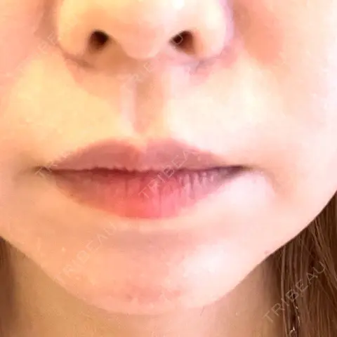 その他（口元） にしまき美容スキンクリニック AFTER