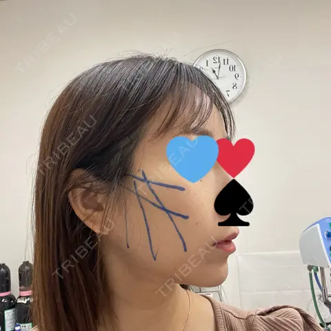 糸リフト ルラ美容クリニック 札幌院 AFTER