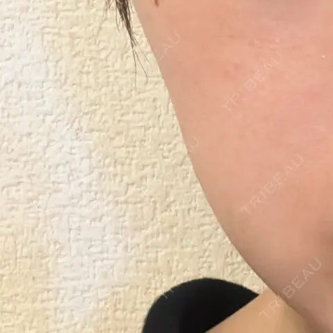 脂肪溶解注射（顔） TCB東京中央美容外科 草津院 AFTER