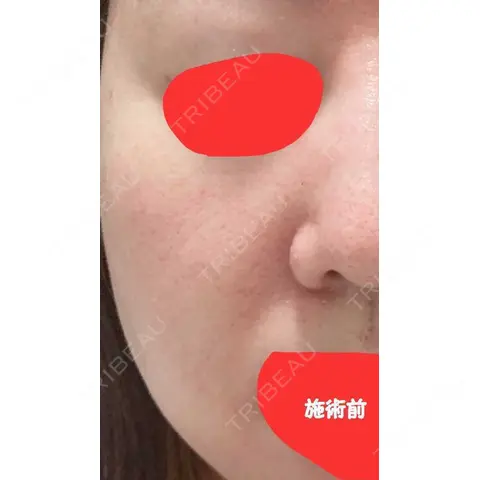 肌ヒアルロン酸注入（たるみ・シワ改善） A CLINIC（エークリニック） 福岡院 AFTER