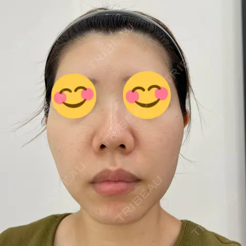 ポテンツァ DAILY SKIN CLINIC 福岡院 BEFORE