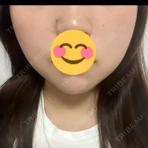 ボトックス（エラ・小顔） 共立美容外科 梅田院 AFTER